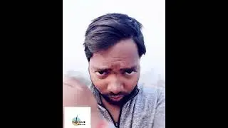 9.5 Month Minoxidil Update(best result from minoxidil/finastride and multivitamins)
