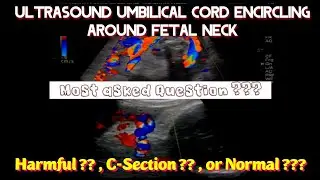 Ultrasound Umbilical Cord, Encircling Fetal Neck .Most asked Question, Harmful, C-Section ,Normal ??