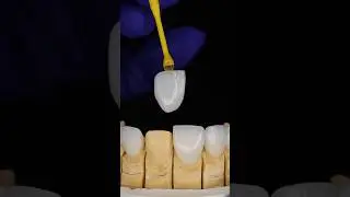 Cost of Porcelain veneers 🦷💰 #veneers #dentalveneers #costofveneers #priceofveneers #veneerprice