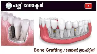 ബോൺ ഗ്രാഫ്റ്റിങ്  / Dental Bone Grafting: Restoring Foundation for a Healthy Smile