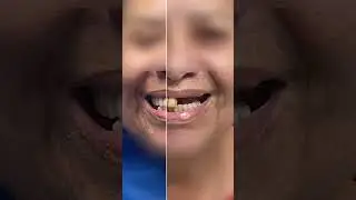 A emoção de realizar um sonho! #implante #dentista