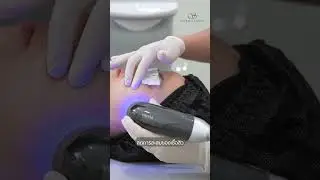 ลดสิวที่ต้นตอ ด้วย Plasma Clear l Sera Clinic