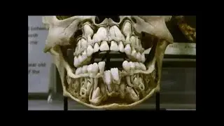 18 Ancient Giant Skeletons Discovered in Wisconsin! Double Row of Teeth, 6-Fingers, 6-Toes, Nephilim