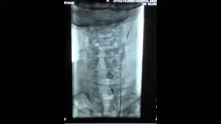 Stent deployment - ACCULINK