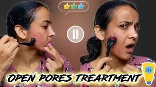 My Derma Roller Journey Part - 3 | Derma Roller For Open Pores