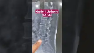Листез 1 степени L4-L5... Доктор Саи Чандра