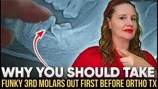 Sometimes 3rd Molars Wisdom Teeth Have to Extract b/f Invisalign or Braces- 2nd molar Super-eruption