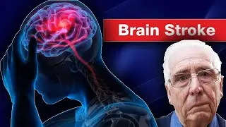 Brain Stroke -- |Symptoms, Causes, Treatment & Recovery| How Doctors Think