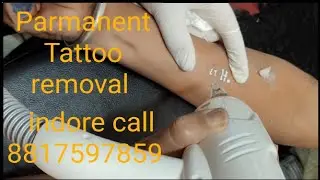 PARMANENT TATTOO REVOVAL INDORE MP CALL 8817597859