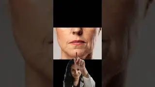 Armonizaci&oacute;n Facial / comisuras ca&iacute;das / boca triste