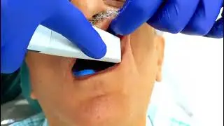 Digital impression in dentistry. Digital Scanning impression.