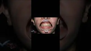 Laser teeth whitening #teeth #whitening #dentist #shorts