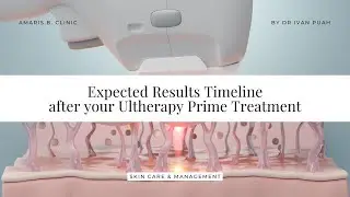 Expected Results Timeline After Your Ultherapy Prime Treatment | Amaris B. Clinic by Dr Ivan Puah