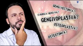 GENGIVOPLASTIA? GENGIVECTOMIA? CIRURGIA GENGIVAL? SAIBA A DIFERENÇA!!! #drrowanvilar