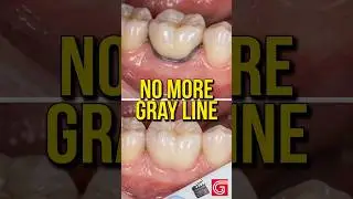 КАК УДАЛИТЬ СТАРУЮ ПАНЕЛЬНУЮ КОРОНКУ С ПЕРЕДНЕГО ЗУБА #стоматология