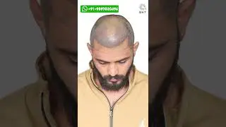 Best Hair Transplant Results | Latest Fue Technique #shorts #viral #hair transplant