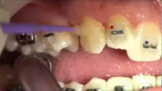Orthodontic Brace Fitting West London Orthodontist Dr. Chaw Su Kyi