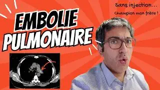 Le diagnostic exceptionnel : Embolie Pulmonaire sur scanner SANS INJECTION