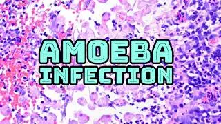 Amoeba infection under microscope (entamoeba amoebiasis disease parasitology histology pathology)
