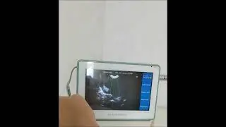 Bladder scanner / Scanner v&eacute;sical AvantSonic Z3