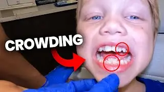 Teeth Crowding! Does he need an EXPANDER? | McKinney Orthodontist