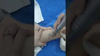 Tattoo was completely removed in just 30 seconds using pico laser technology #tattoo #laser