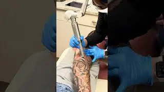 Tattoo Removal is a great procedure to have done with the Pico Laser #tattooremoval #tattoolover