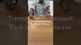 A person with tremors of right hand caused by Parkinson&rsquo;s Disease
