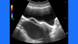 Large Simple Ovarian Cyst with Early Pregnancy | Ultrasound Findings, Prognosis & Management