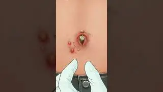 ASMR Remove Navel Stone Belly Button Ring Animation #shorts #treatment #asmr