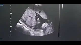 Cordocentesis