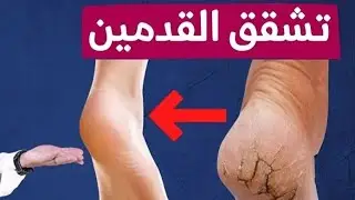 وداعا لتشققات و جفاف الاقدام: كريم Xerial SVR مع الدكتورة الصيدلانية نادية