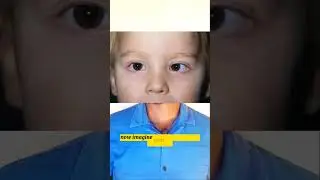 Refractive Accommodative Esotropia