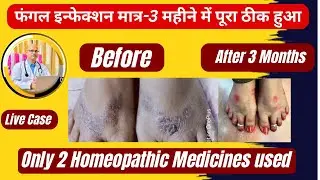 Live case Fungal Infection 100% Cure II Only 2 Homeopathic Medicines used #fungalinfectiontreatment