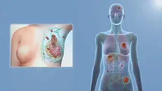 Management of Hormone Positive Metastatic Breast Cancer
