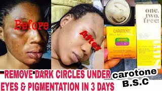 REMOVED DARK EYES CIRCLES IN 3 DAYS WITH CAROTONE & SUNSCREEN CREAM