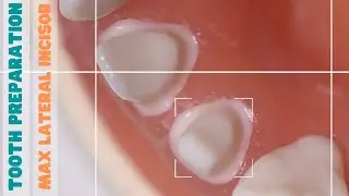 Tooth Preparation 🔵 Maxillary Lateral Incisor 🟡 PFM