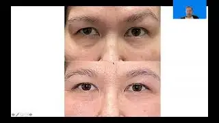Upper Blepharoplasty result with Dr. John Burroughs at Springs Aesthetics, in Colorado Springs