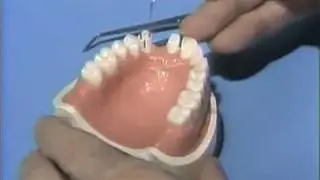Vinyl Polysiloxane Impression for Anterior Bridge