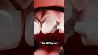কিভাবে দাঁতের ফিলিং করতে হয় | How to do a dental filling | Education Films