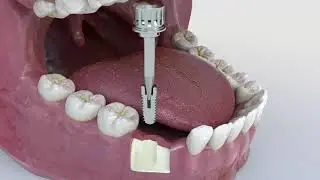 Extractor de Implantes GMI