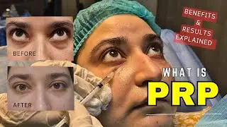 Trying Under Eye PRP Treatment | Dark Circles Treatment Review (Part 1)