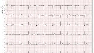 Basic of ecg part 1 #ecg