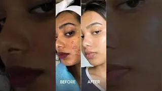 Filters off. Confidence on.🔥 #acnefreeskin #clinic7