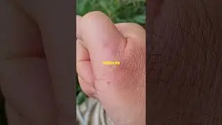 Surviving a Scorpion Sting!