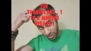 HAIR GROWTH CENTRE LONDON. MAIDA VALE.  FUE TRANSPLANT CROWN TIMELINE. 1-2 MONTHS.