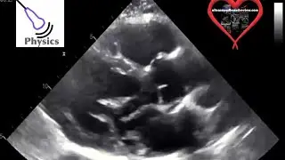 Side Lobe Artifact