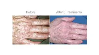 Lumecca Complete Skin Rejuvenation and Pigment Treatment by INMODE Available at Dermaspa