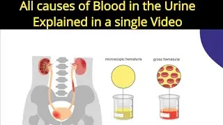 #urine men #blood ane ki tmam wajuhat in #urdu | #painful vs non-painful; which is more #dangerous ?
