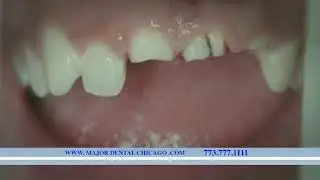 Dental Implants Major Dental Clinics Chicago